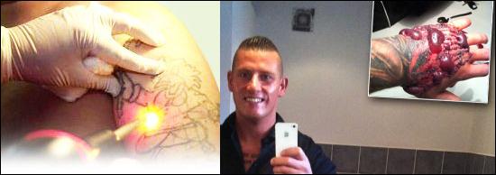 Sikker fjernelse af tatovering - Sådan gør du Sikker fjernelse af tatovering - Sådan gør du